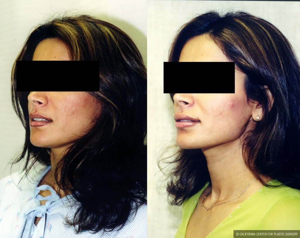 Facial Cosmetic Surgery Before & After Patient #10482