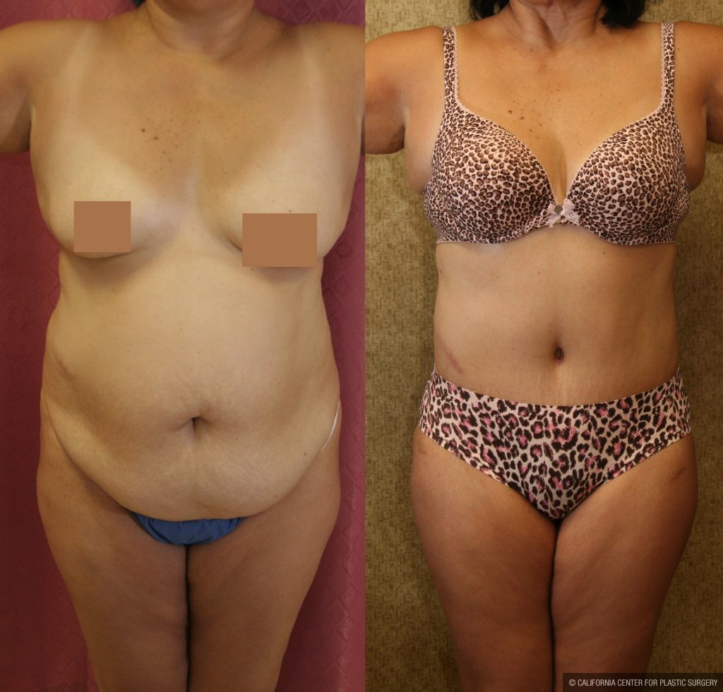 Body Contouring Before & After Patient #10396