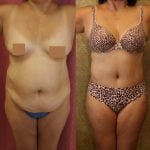 Body Contouring Before & After Patient #10396