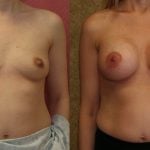 Breast Augmentation Before & After Patient #10795