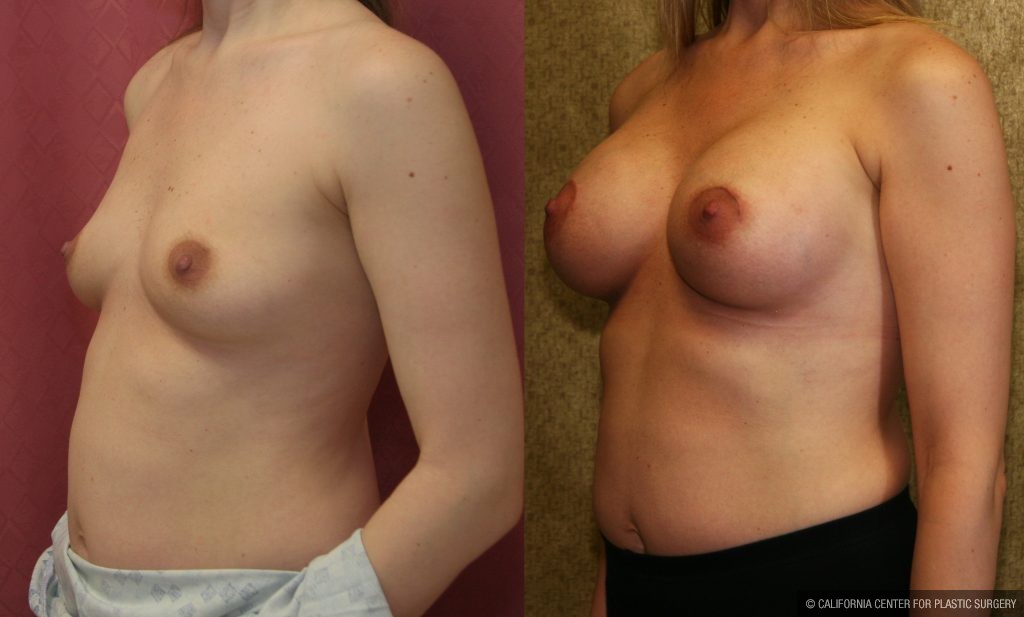 Breast Augmentation Before & After Patient #10795