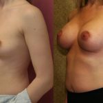 Breast Augmentation Before & After Patient #10795