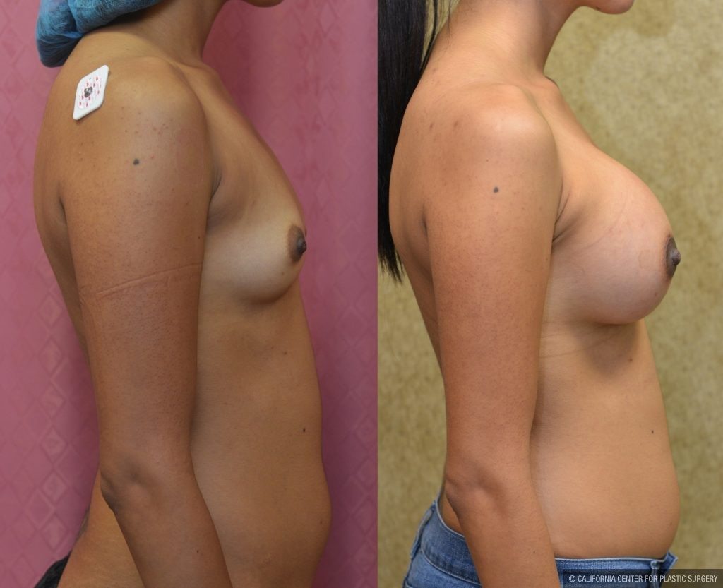 Breast Augmentation Before & After Patient #10808