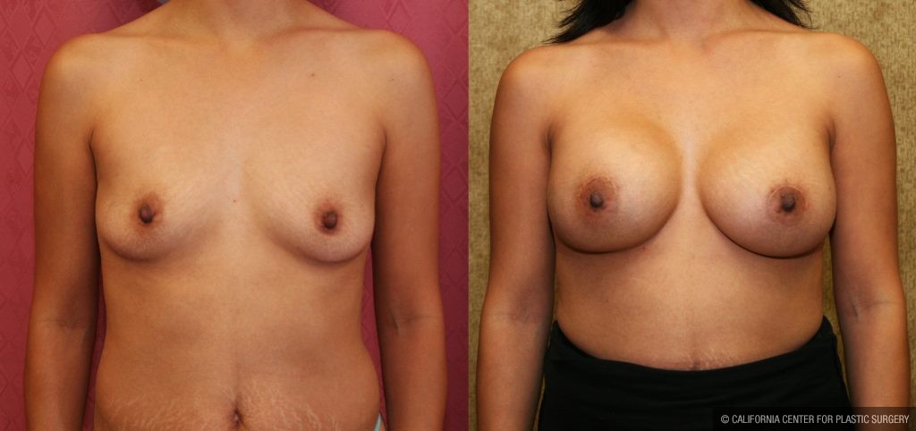 Breast Augmentation Before & After Patient #10812