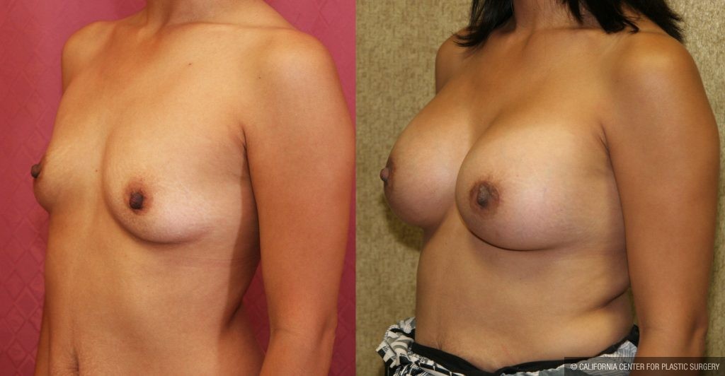 Breast Augmentation Before & After Patient #10812