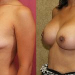 Breast Augmentation Before & After Patient #10812