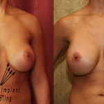 Breast Augmentation Before & After Patient #10816