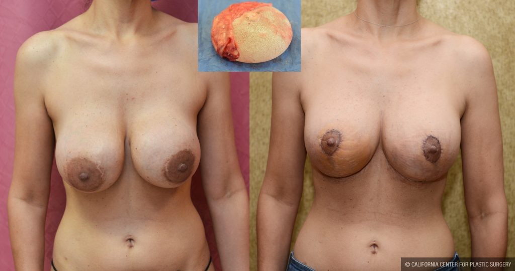 Breast Augmentation Before & After Patient #10822