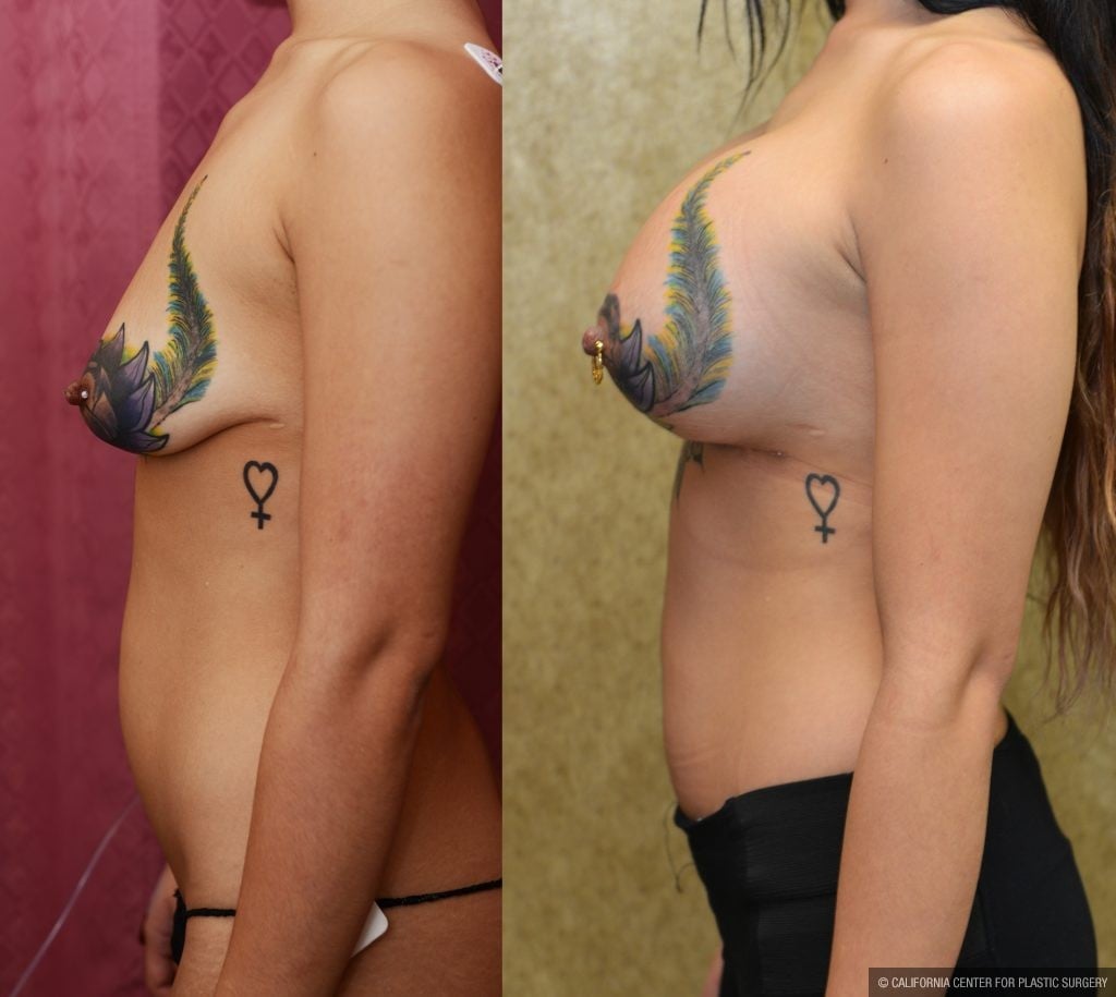 Pin on Breast lift