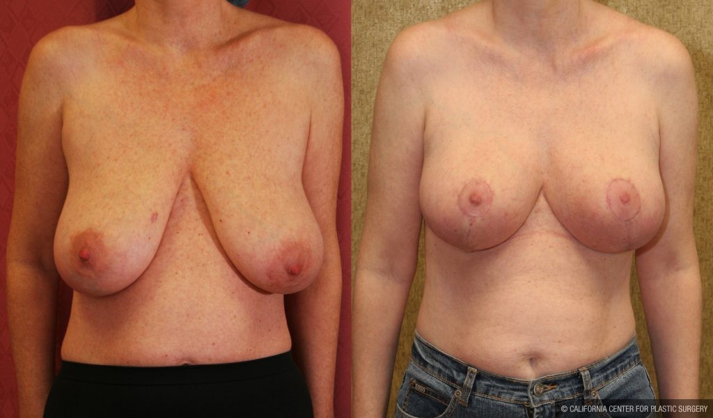 Breast Lift (Mastopexy) Before & After Patient #10826