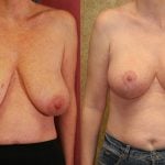 Breast Lift (Mastopexy) Before & After Patient #10826