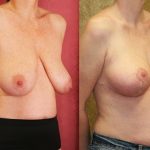 Breast Lift (Mastopexy) Before & After Patient #10826