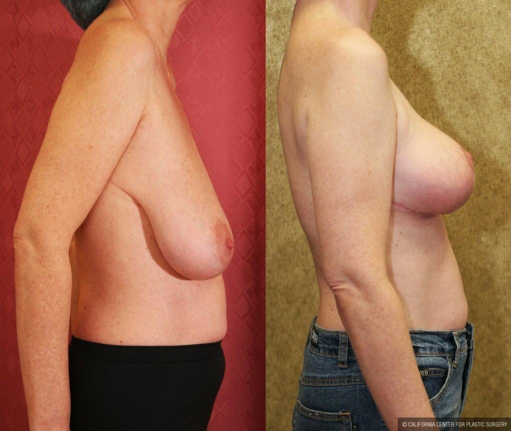 Breast Lift (Mastopexy) Before & After Patient #10826