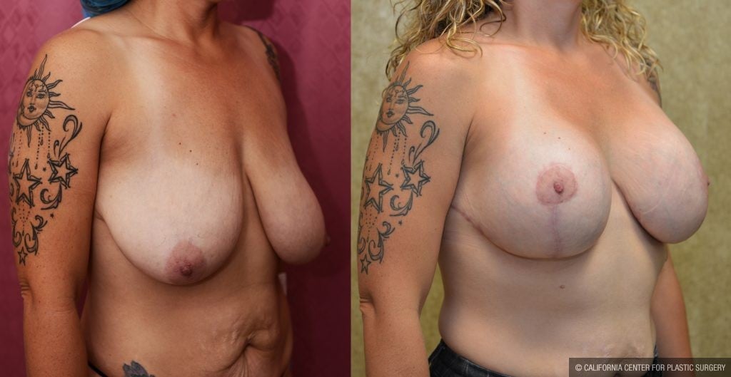 Breast Lift (Mastopexy) Before & After Patient #10831