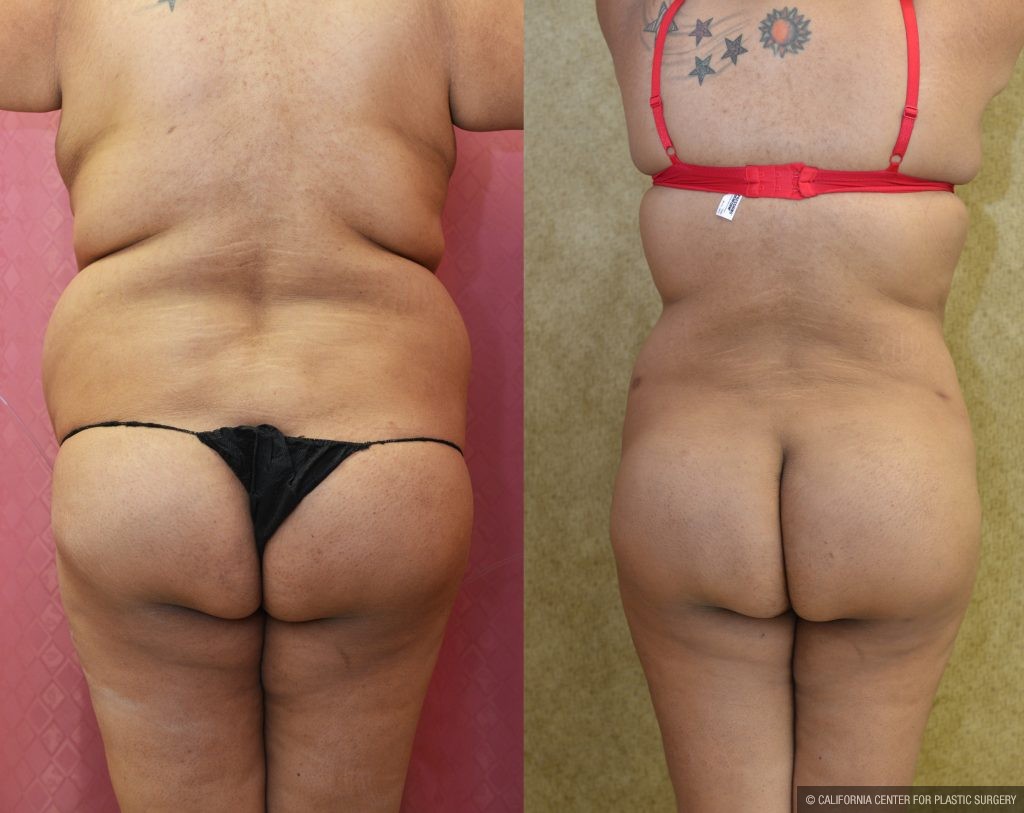 Buttock Lift/Augmentation Before & After Patient #10844
