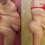 Buttock Lift/Augmentation Before & After Patient #10844