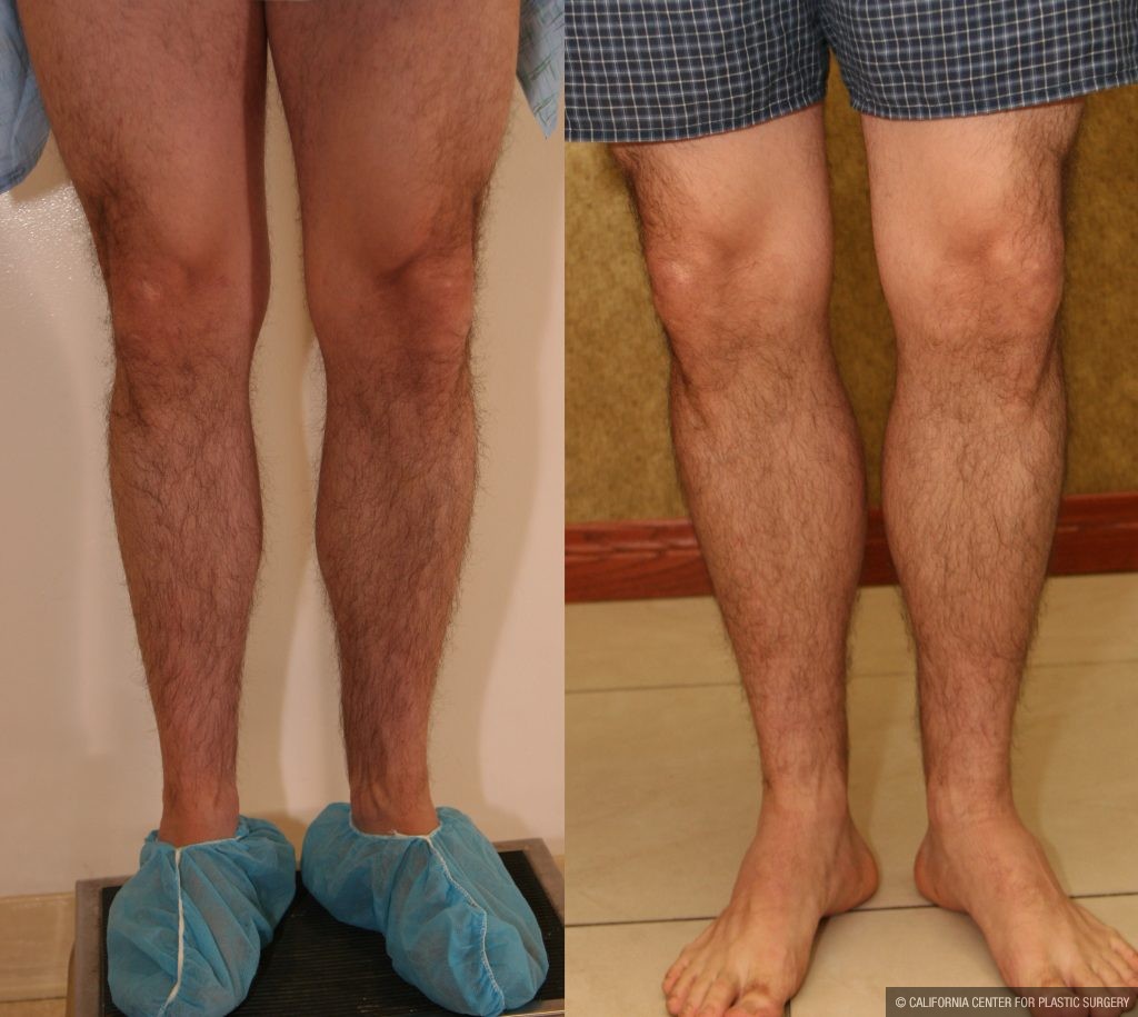 Calf Augmentation Before & After Patient #10877