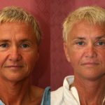 Facelift Before & After Patient #10940