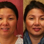 Rhinoplasty - Asian Before & After Patient #11009