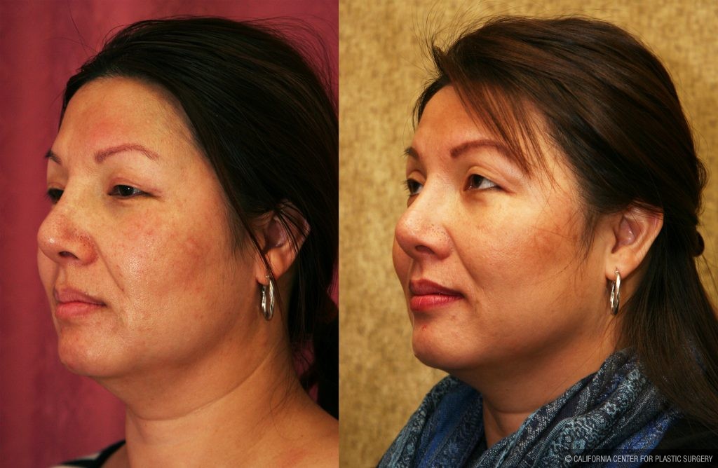 Rhinoplasty - Asian Before & After Patient #11009