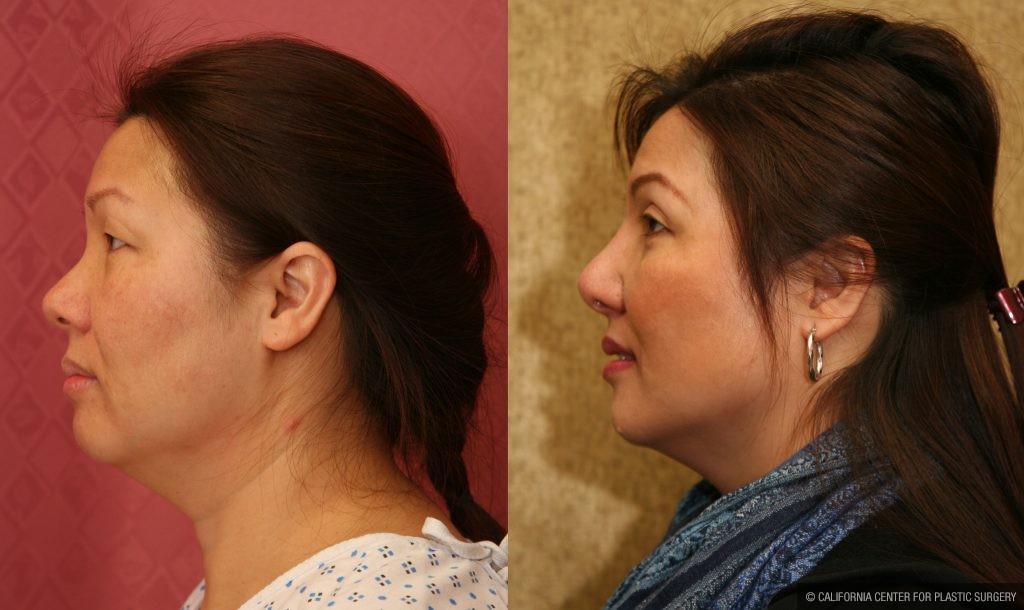 Rhinoplasty - Asian Before & After Patient #11009