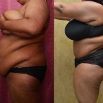 Tummy Tuck (Abdominoplasty) Plus Size Before & After Patient #11037