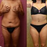 Tummy Tuck (Abdominoplasty) Small Size Before & After Patient #11056