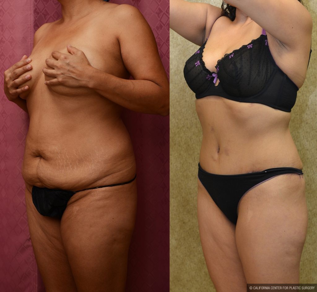 Tummy Tuck (Abdominoplasty) Small Size Before & After Patient #11056