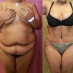 Tummy Tuck (Abdominoplasty) Plus Size Before & After Patient #11060