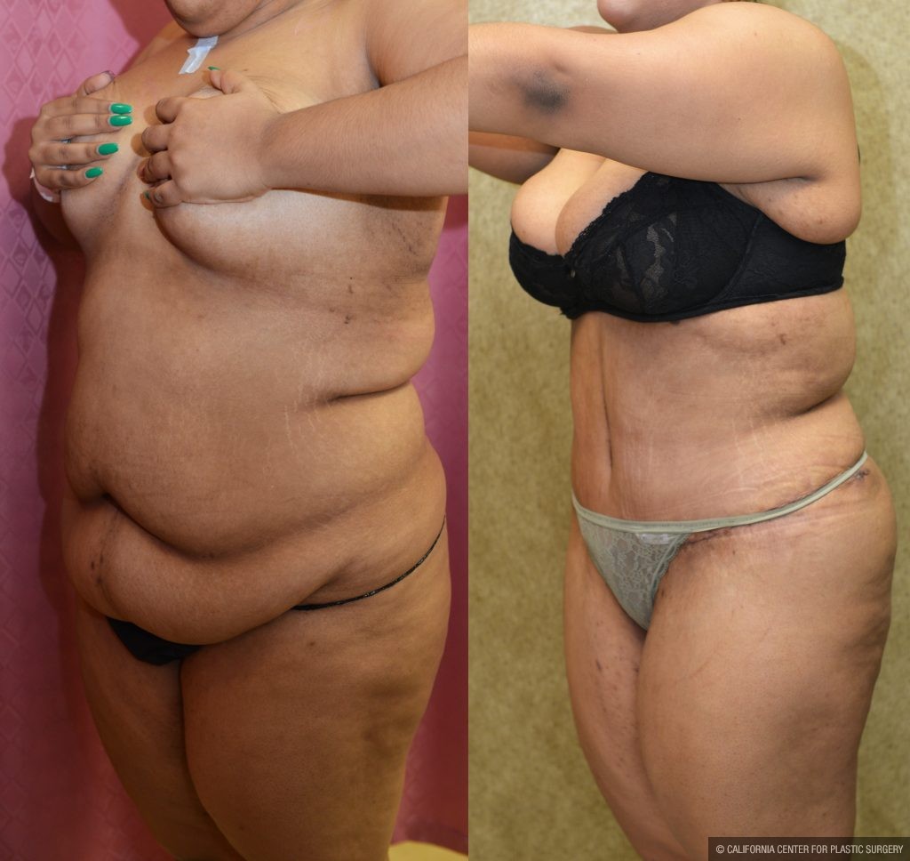 Tummy Tuck (Abdominoplasty) Plus Size Before & After Patient #11060