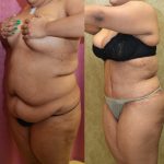 Tummy Tuck (Abdominoplasty) Plus Size Before & After Patient #11060