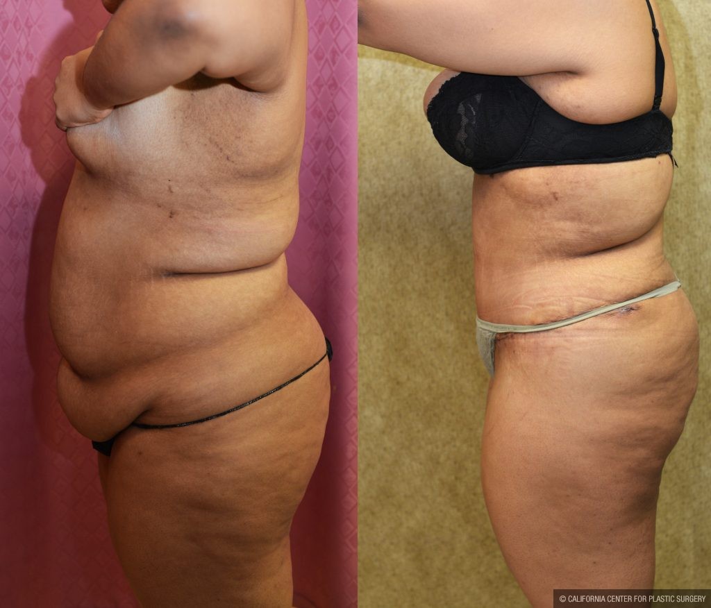 Tummy Tuck (Abdominoplasty) Plus Size Before & After Patient #11060