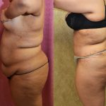 Tummy Tuck (Abdominoplasty) Plus Size Before & After Patient #11060