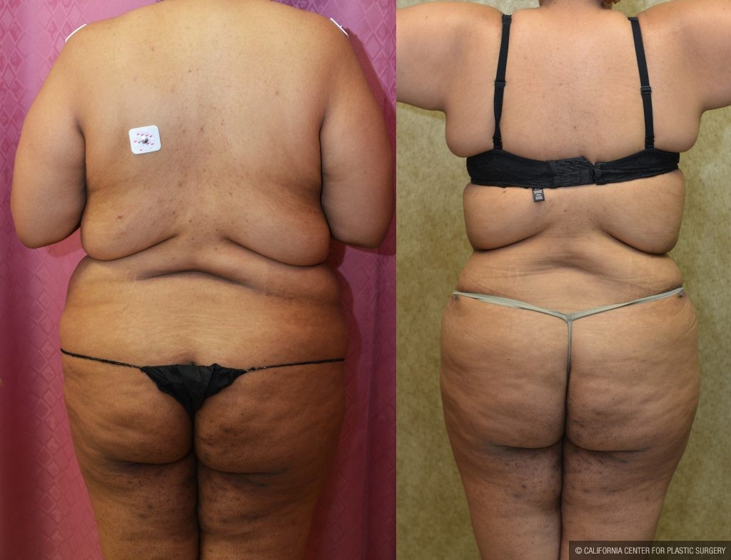 Tummy Tuck (Abdominoplasty) Plus Size Before & After Patient #11060
