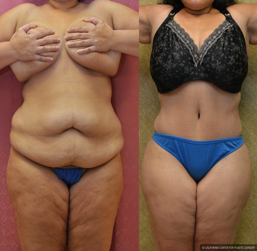 Tummy Tuck (Abdominoplasty) Plus Size Before & After Patient #11065