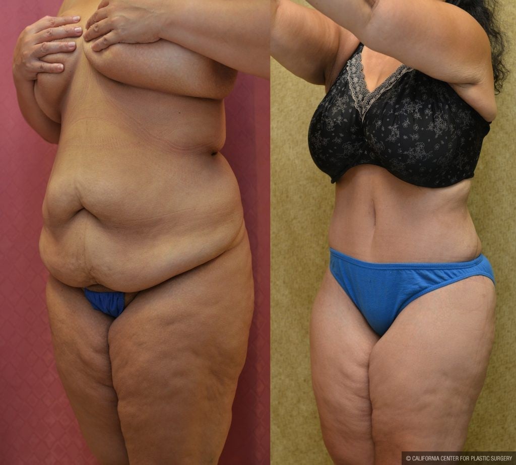 Tummy Tuck (Abdominoplasty) Plus Size Before & After Patient #11065