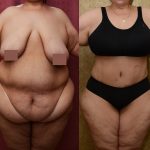 Tummy Tuck (Abdominoplasty) Plus Size Before & After Patient #11070