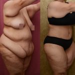 Tummy Tuck (Abdominoplasty) Plus Size Before & After Patient #11070