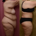 Tummy Tuck (Abdominoplasty) Plus Size Before & After Patient #11070