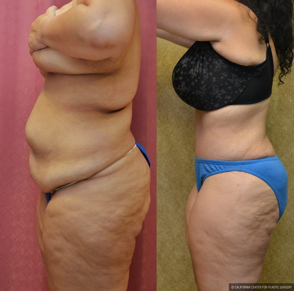 Tummy Tuck (Abdominoplasty) Plus Size Before & After Patient #11065