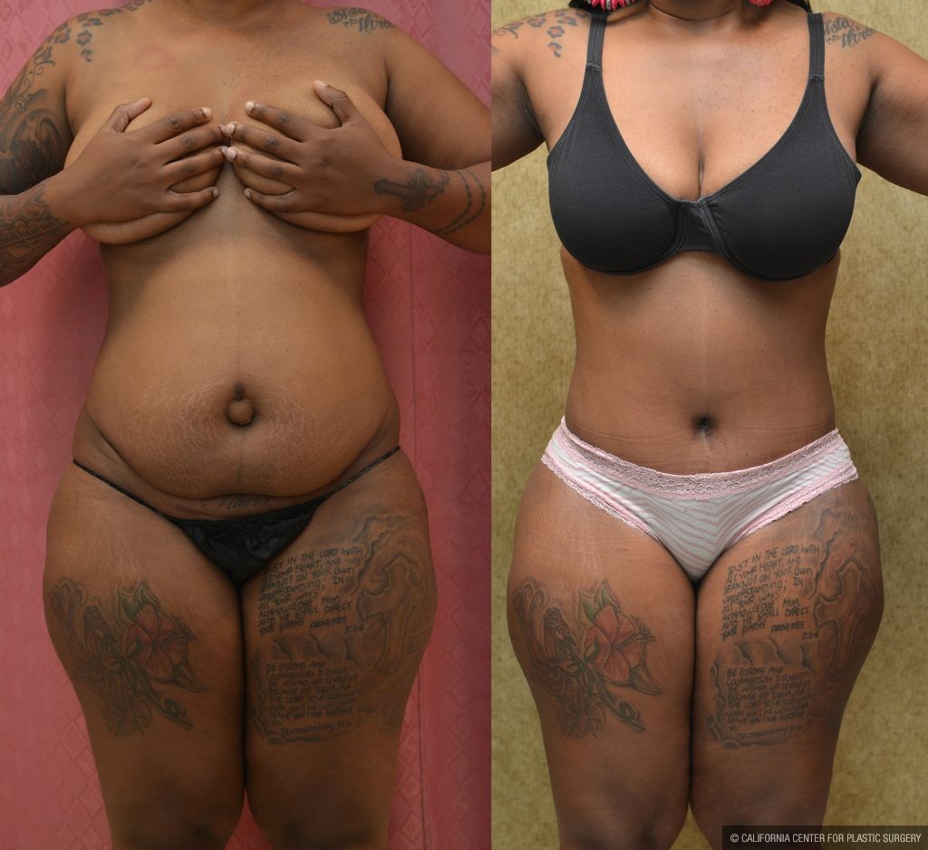 Tummy Tuck (Abdominoplasty) Medium Size Before & After Patient #11046
