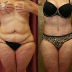 Tummy Tuck (Abdominoplasty) Plus Size Before & After Patient #11029