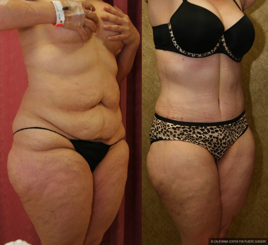 Tummy Tuck (Abdominoplasty) Plus Size Before & After Patient #11029