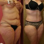 Tummy Tuck (Abdominoplasty) Plus Size Before & After Patient #11029