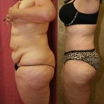 Tummy Tuck (Abdominoplasty) Plus Size Before & After Patient #11029