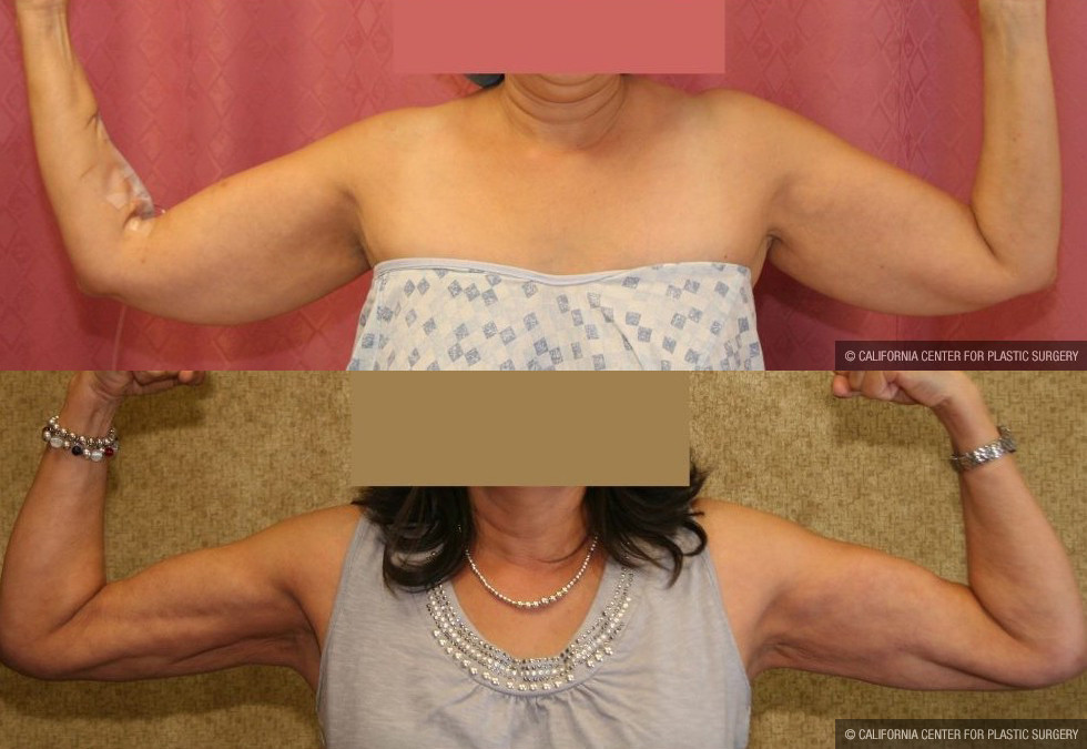 Liposuction Arms Before & After Patient #10977