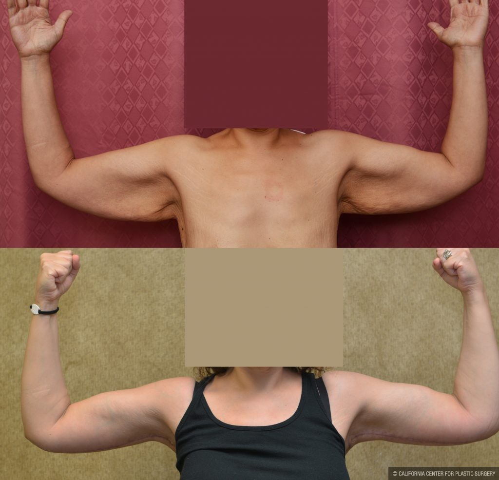Arm Lift (Brachioplasty) Before & After Patient #10840
