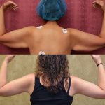 Arm Lift (Brachioplasty) Before & After Patient #10840