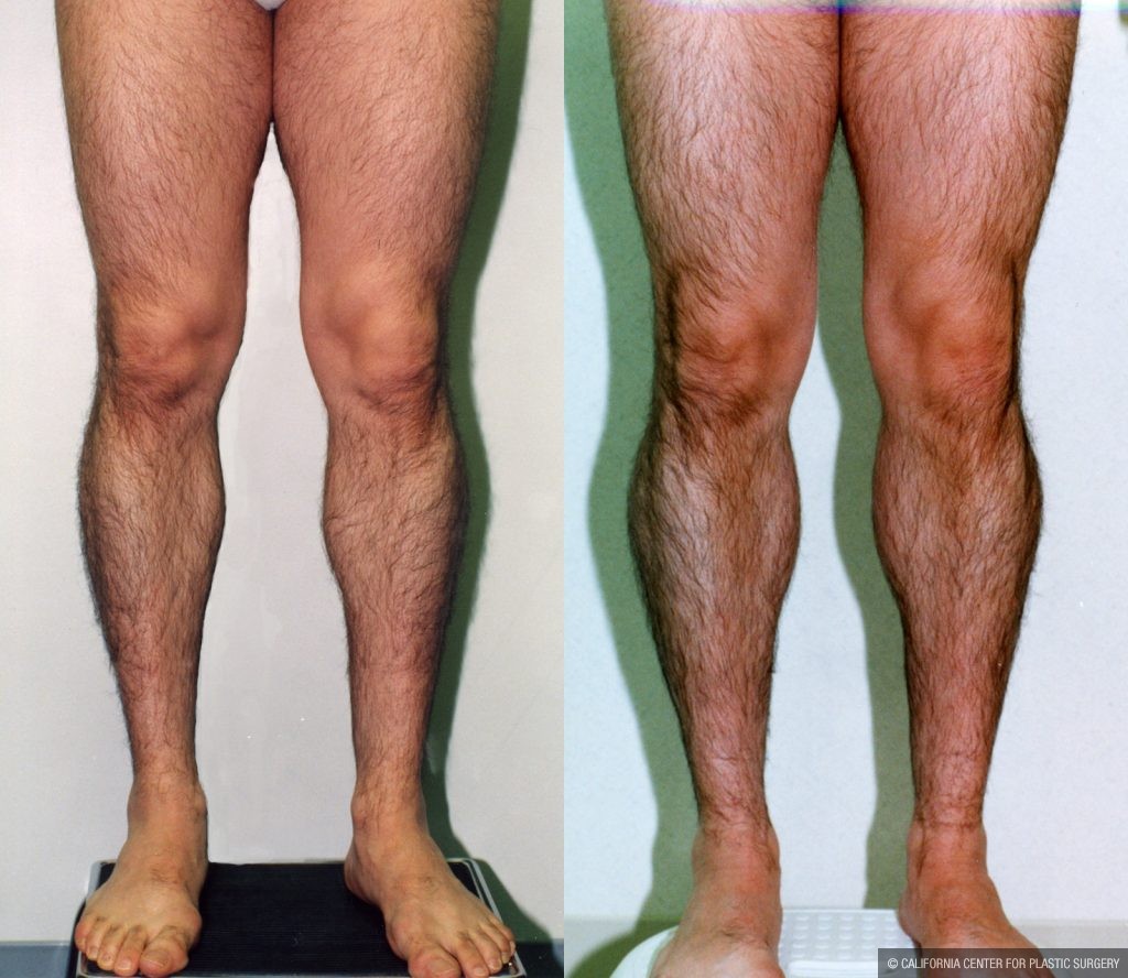 Calf Augmentation Before & After Patient #10912