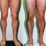 Calf Augmentation Before & After Patient #10912